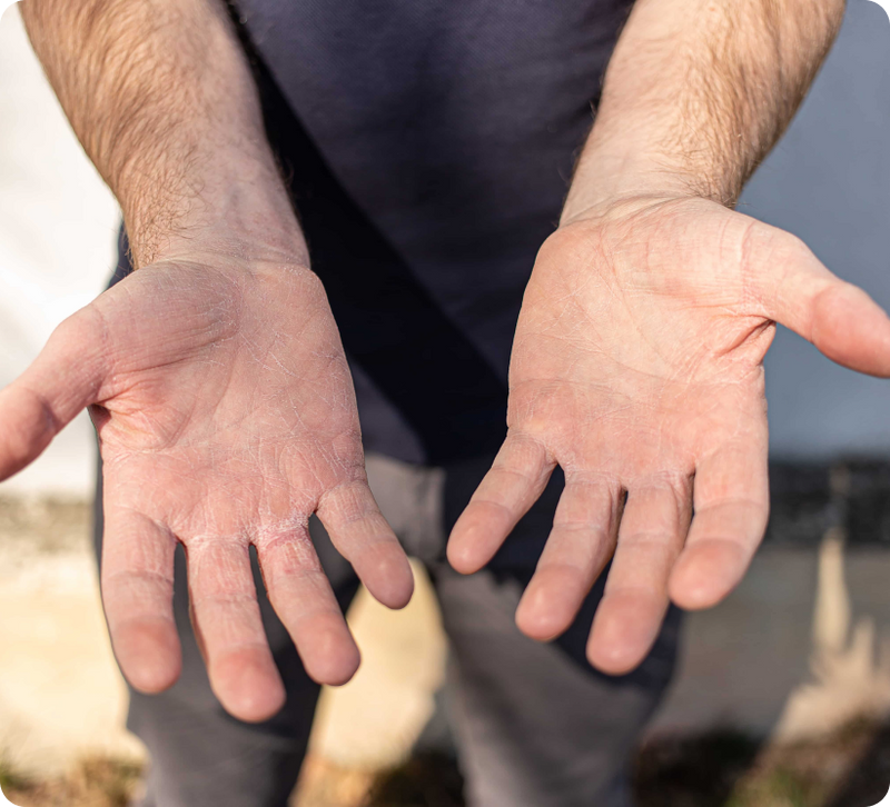 Close-up of a person's forearms and hands, palms facing forward, with dry, cracked skin visible on both hands. The person is wearing a dark gray shirt and gray pants, standing outdoors with a blurred natural background.